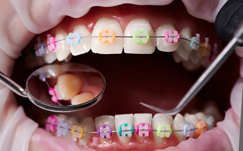 Do Braces Hurt? What to Expect with New Braces