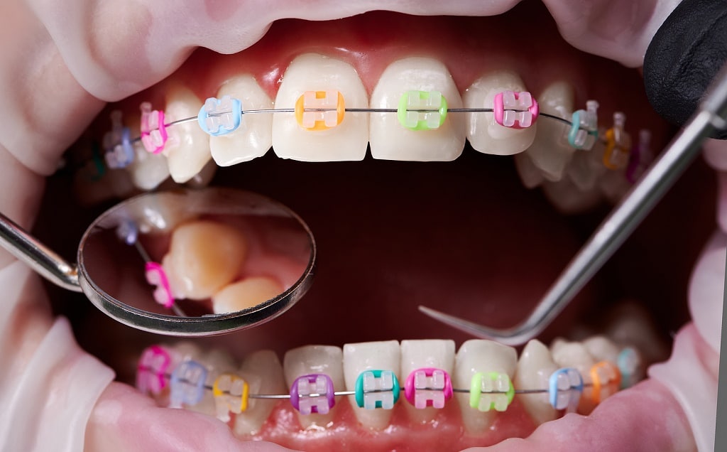 Do Braces Hurt? What To Expect Northeastern Braces