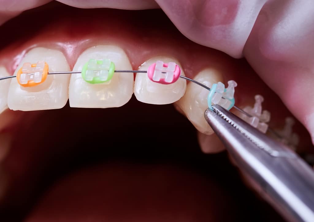 Breaking Brackets: All You Have To Know About Your Broken Braces