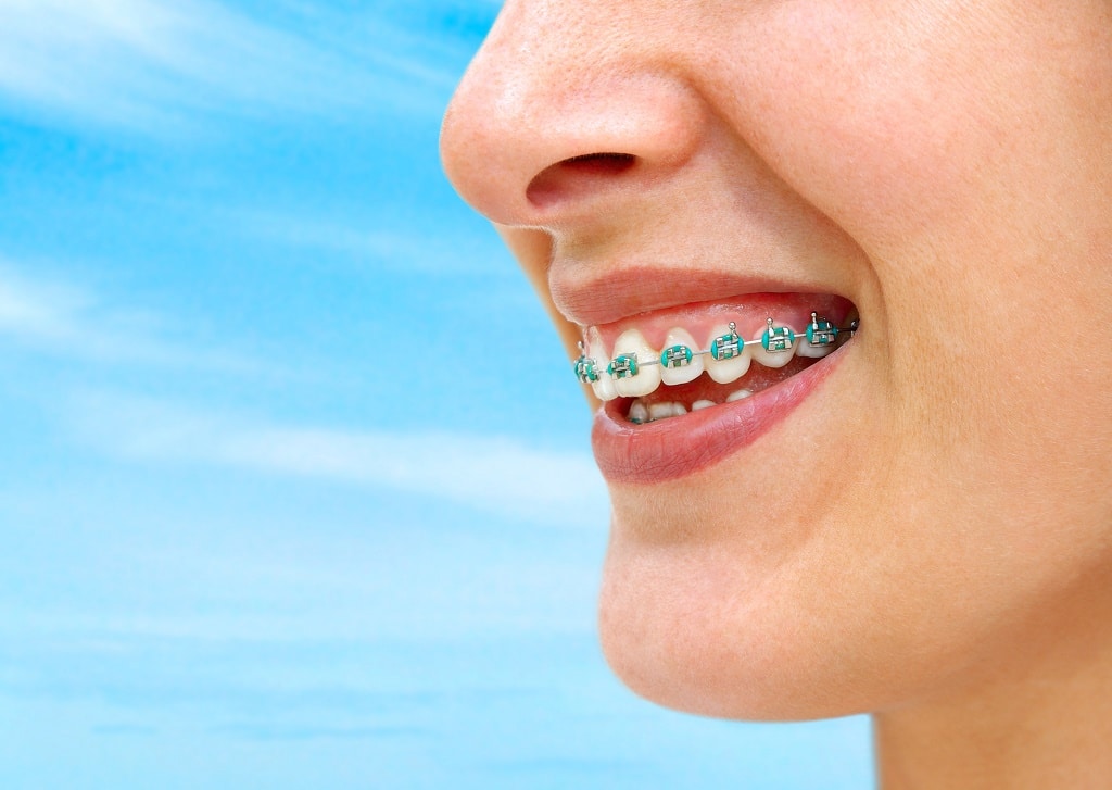 Braces Cleaning Techniques — 5 Surefire Tips for a Winning Smile