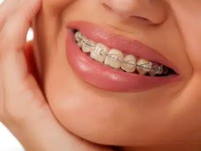How Much do Braces Cost?