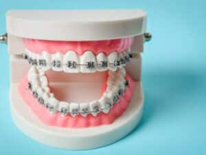 Braces Discomfort Guide: Smart Remedies That Actually Work