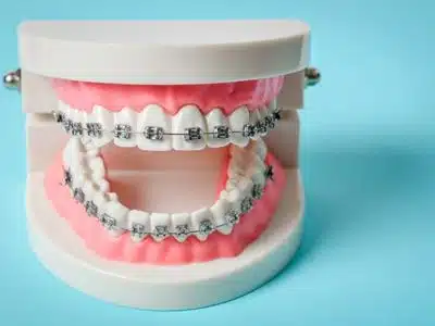 Tips to Follow After Getting Metal Braces Treatment