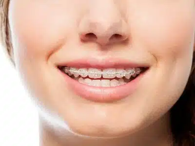 Clear Braces: A Popular Orthodontic Treatment Option