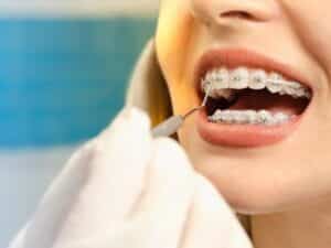 First Week of Wearing Braces