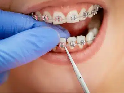 10 Tips to Know About Your First Week of Wearing Braces