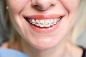 braces Newburgh NY