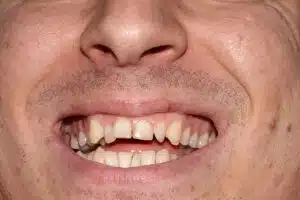 too old for braces