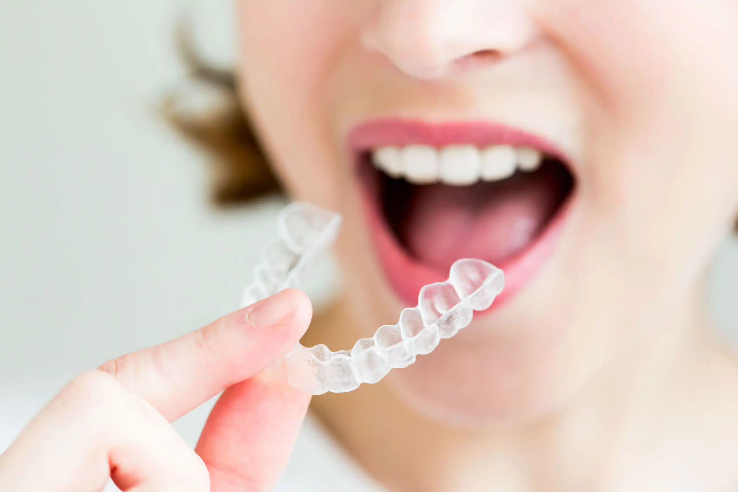 Clear Braces vs. Metal Braces: Expert Comparison for the Best Results