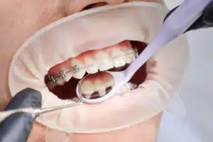 Braces Discomfort Guide: Smart Remedies That Actually Work