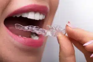 how Invisalign improves oral health