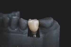 Invisalign with Implants