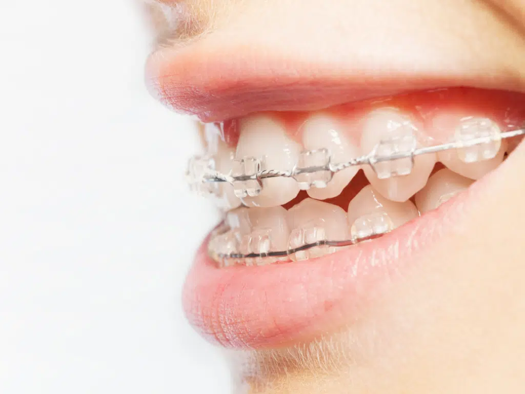 Clear braces discoloration caused by stained elastic ties
