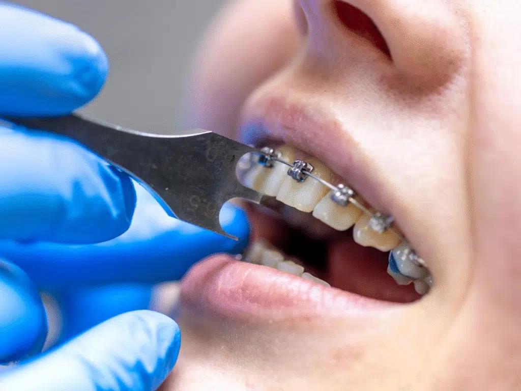 Clear braces MRI safety comparison