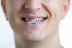 Close-up of an adult man smiling with traditional metal braces on his teeth 