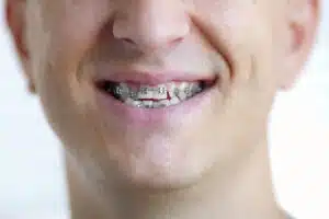Close-up of an adult man smiling with traditional metal braces on his teeth