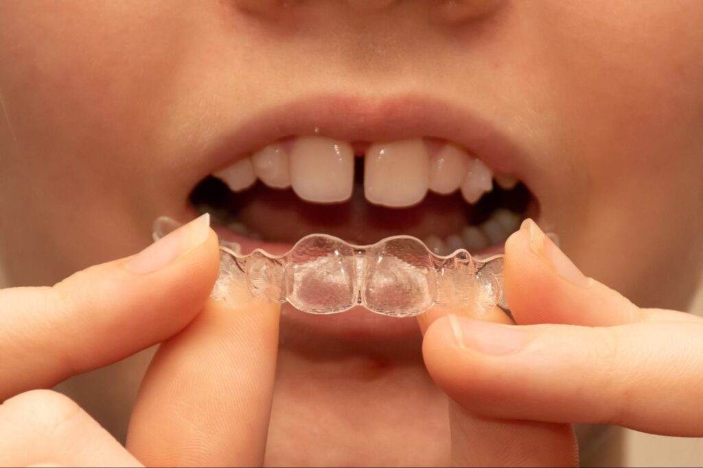 Teen holding Invisalign aligners