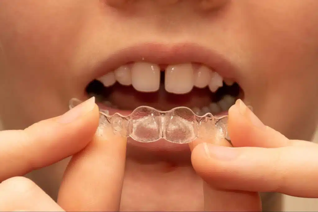 Teen holding Invisalign aligners
