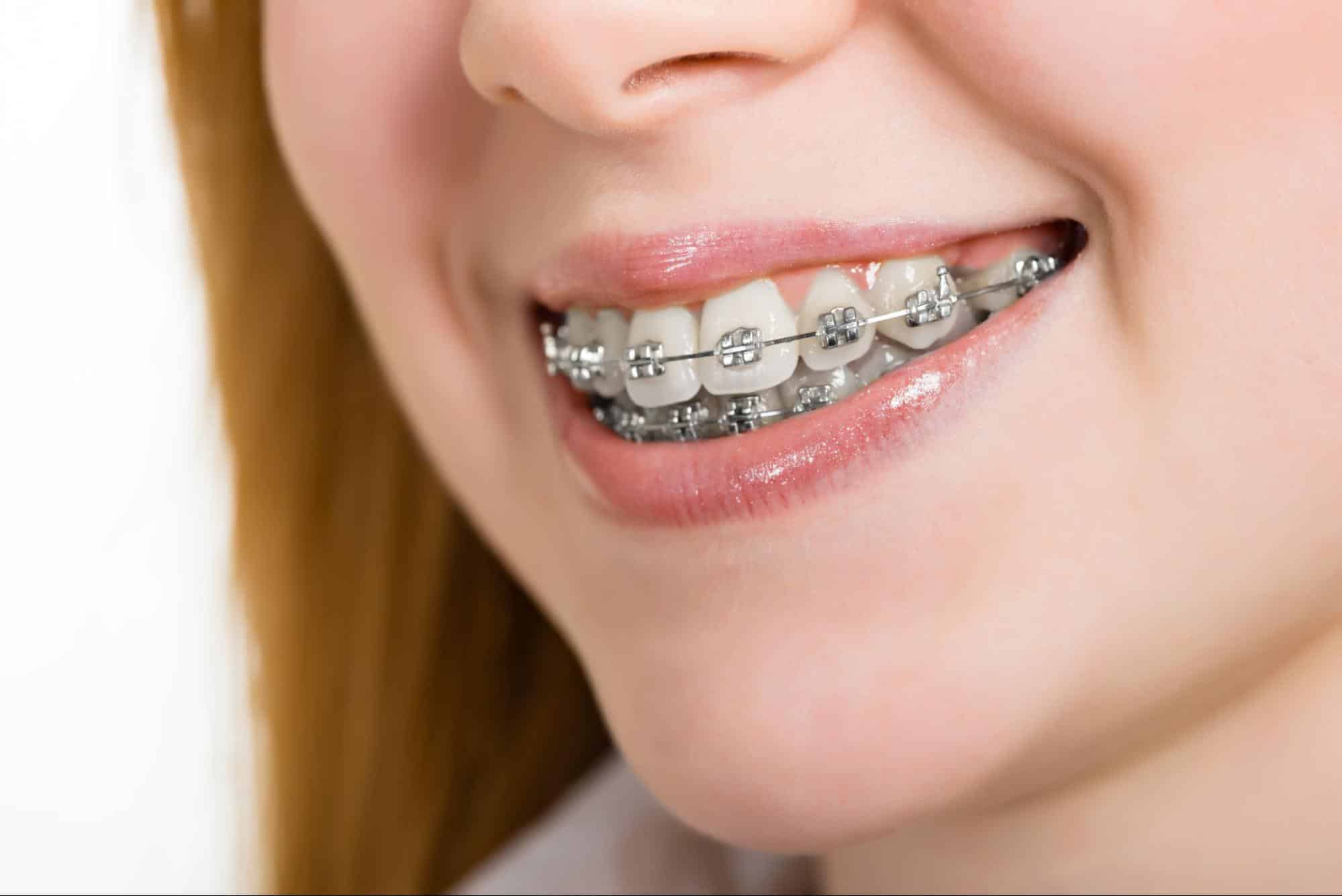 Patient wearing braces for bite correction treatment