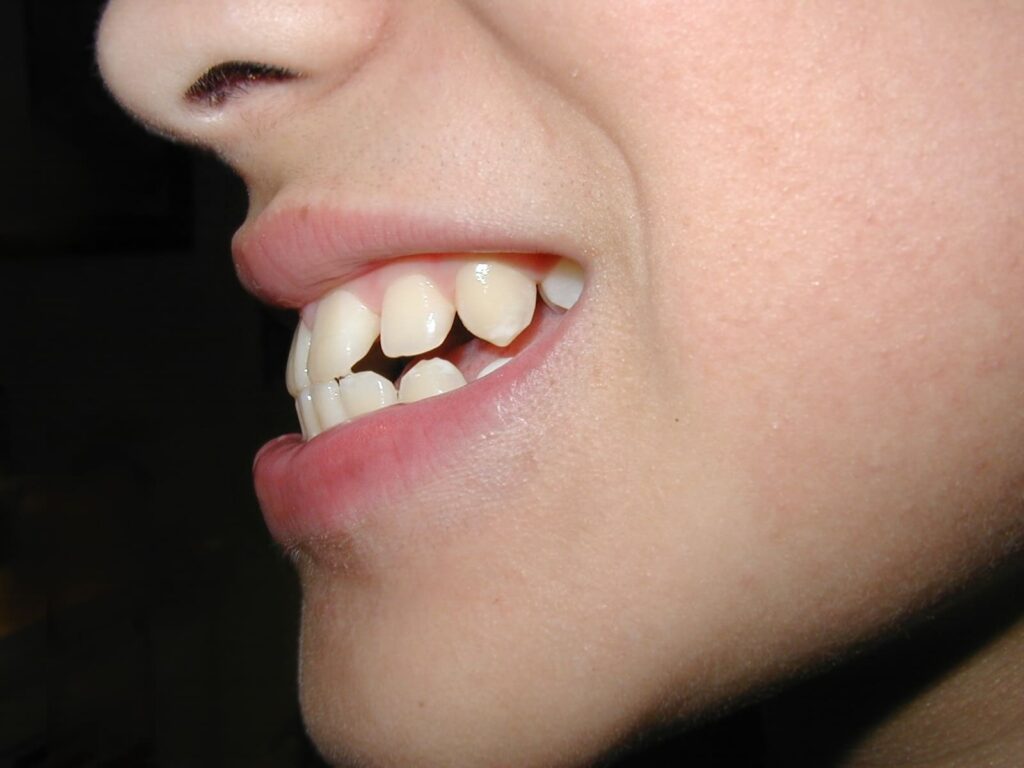 Patient with overbite