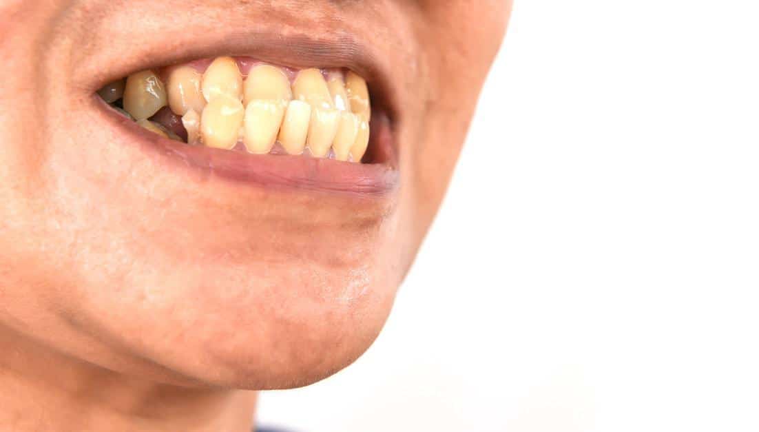 patient with underbite