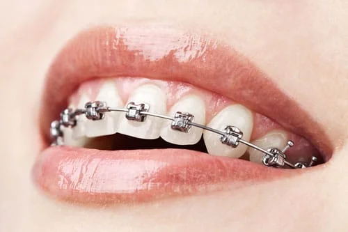 Metal Braces Newburgh NY