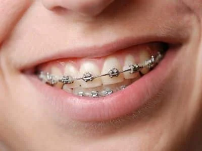 Getting Metal Braces