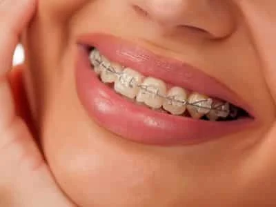 Clear Braces