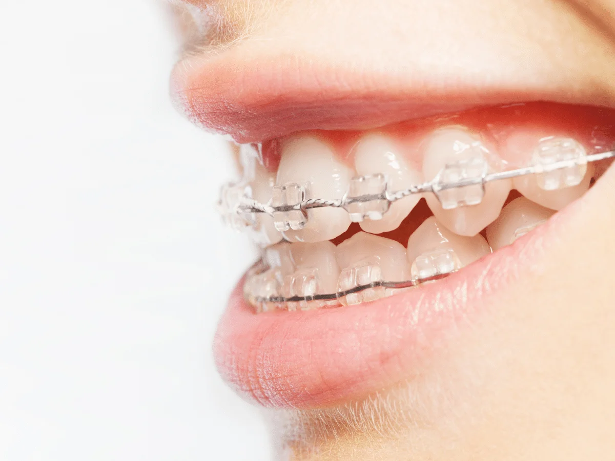 Clear braces discoloration caused by stained elastic ties