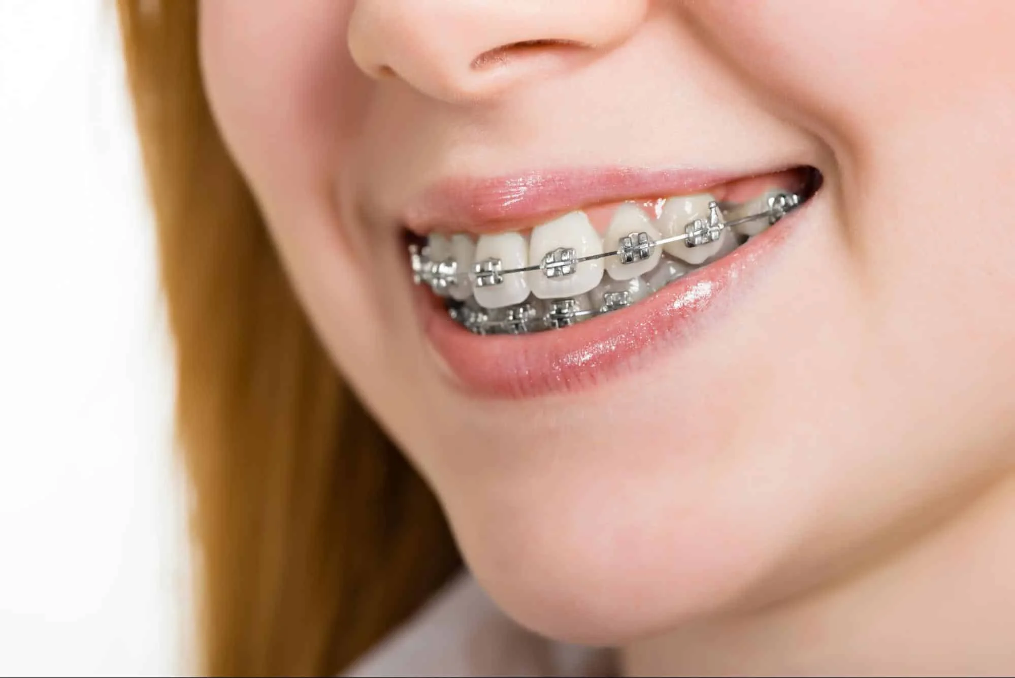 Patient wearing braces for bite correction treatment